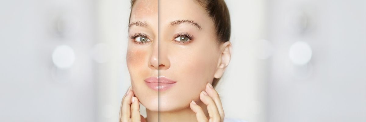 Aşırı Cilt Yağlanmasına Karşı Alınabilecek Önlemler