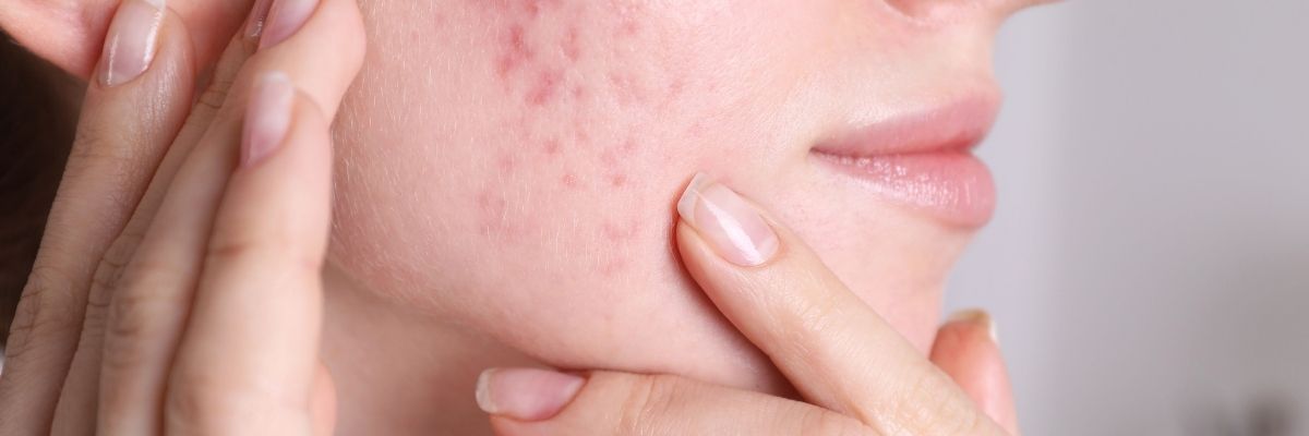 Hormonal Akne Nedir, Belirtileri Nelerdir