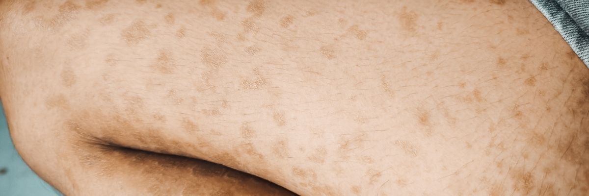 Fungal Akne Belirtileri