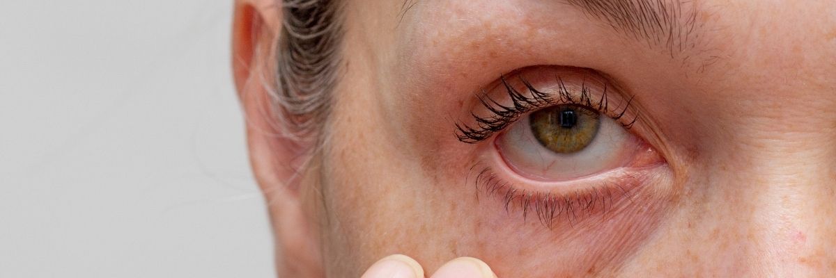 Göz Altı Torbalarına Çözüm